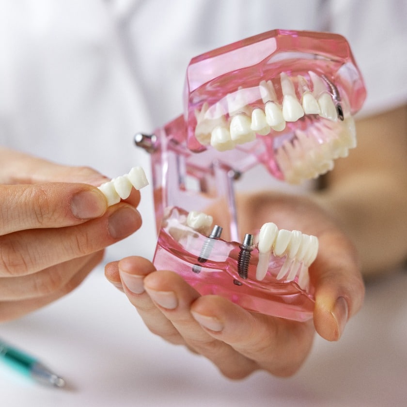dentist implantologist showing dental bridge implant technology on human tooth jaw model